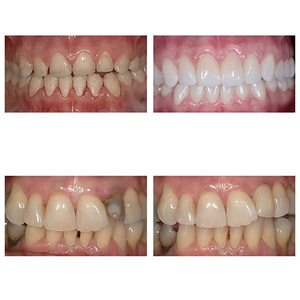 Protesi fisse e mobile